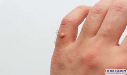 Verrugas: o que você precisa saber sobre elas