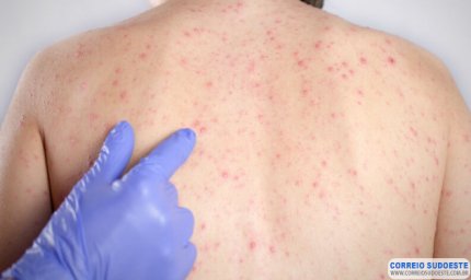 SARAMPO: crianças que se deslocarem para municípios em situação de risco devem ser vacinadas