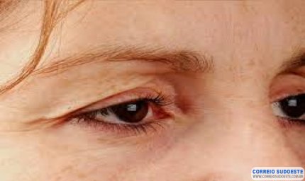 Lentes de contato podem levar à queda da pálpebra