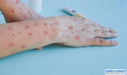 OMS declara Mpox como emergência em saúde pública global