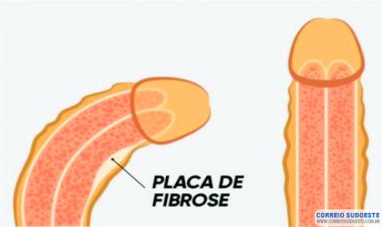 JÁ OUVIU FALAR NA DOENÇA DE PEYRONIE OU SIMPLESMENTE PÊNIS TORTO?