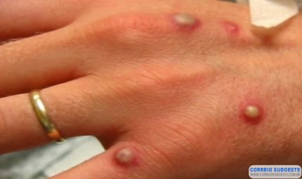 Casos suspeitso de Monkeypox em Guaxupé aguardam resultado