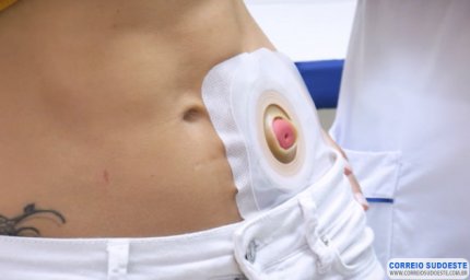 O que é ostomia e como ela afeta a qualidade de vida das pessoas