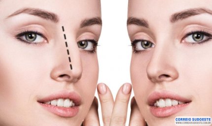 RINOPLASTIA DEVE SER AVALIADA COM CUIDADO PARA NÃO GERAR GATILHOS EMOCIONAIS