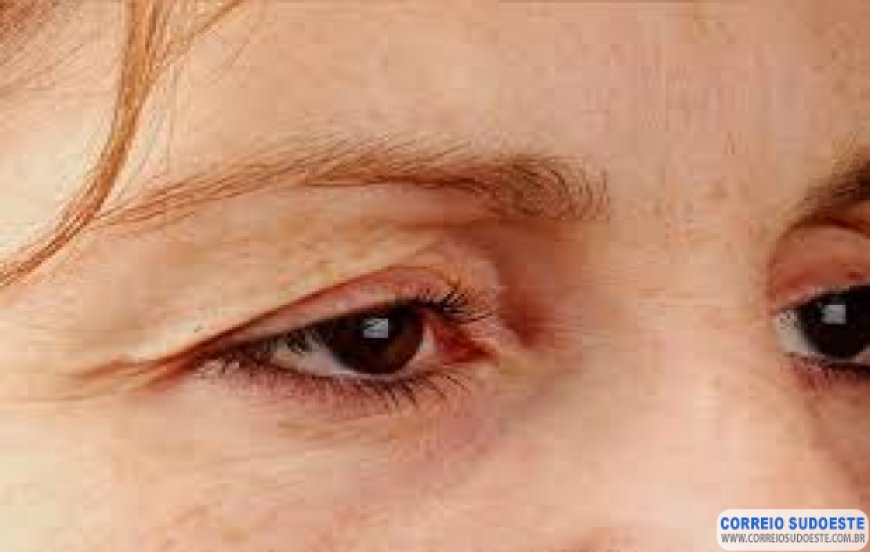 Lentes de contato podem levar à queda da pálpebra