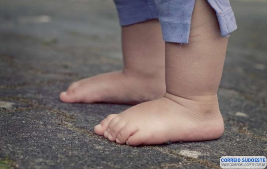 Pé chato em crianças a partir dos 7 anos deve ser avaliado por especialistas